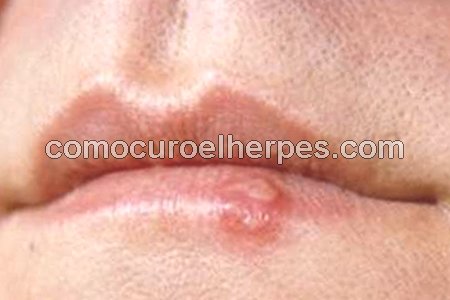 Qué es el herpes labial