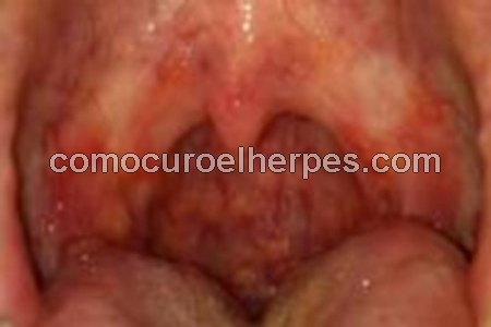 Síntomas de herpes en la garganta