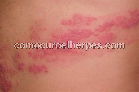 Lesiones de herpes zóster (Cómo se contagia la culebrilla)