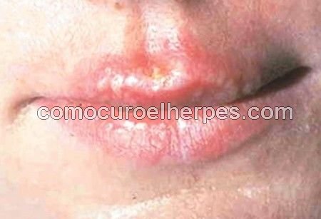 Hombre con síntomas del herpes labial u oral