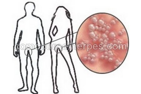 Hombre y mujer con herpes (Síntomas del herpes genital)