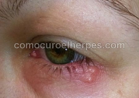 Persona con herpes en el ojo