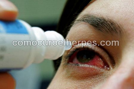 Herpes en el ojo tratamiento
