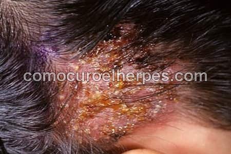Lesiones de herpes en el cuero cabelludo