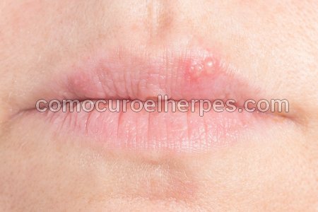 Ampollas de herpes en la boca (síntomas)
